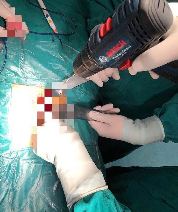 寧夏醫(yī)科大學(xué)總醫(yī)院成功應(yīng)用3D打印導(dǎo)板技術(shù)