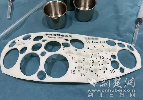 醫生用3D打印模板為患者定好18個點位精準植入粒子