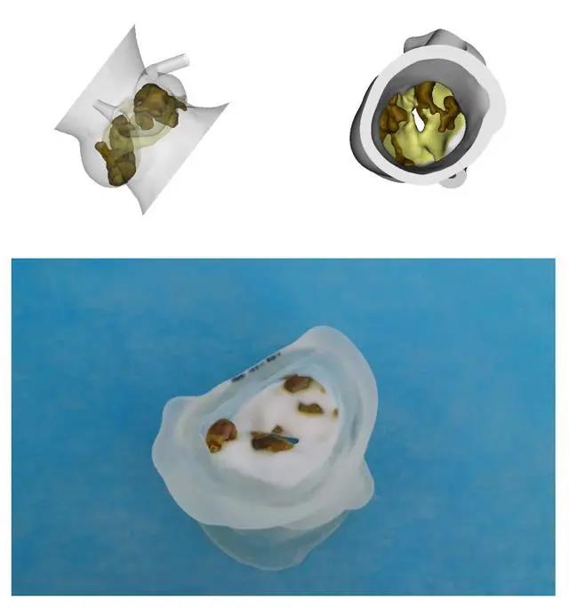 江西首例！3D打印技術換心臟瓣膜 更加精準