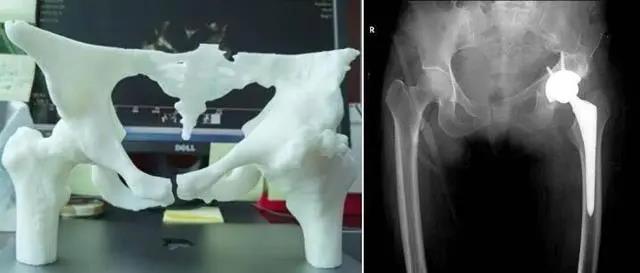 股骨壞死20年 3D打印助陣換髖
