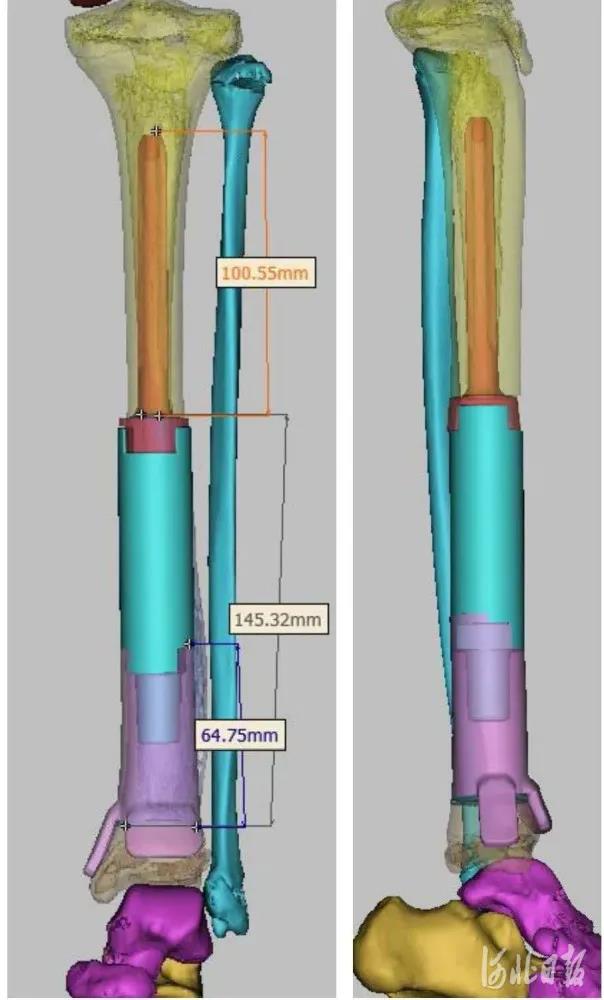 河北省首例！骨腫瘤女童植入3D打印假體，保肢成功！