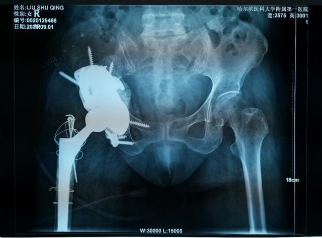 哈醫大一院完成金屬3D打印三翼髖臼假體全髖關節翻修術