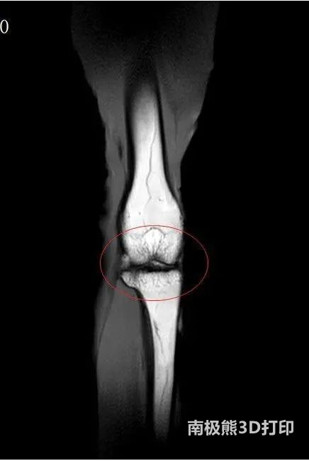 老年人膝蓋疼、走路難？關(guān)節(jié)軟骨老化有望用3D打印技術(shù)恢復(fù)如初
