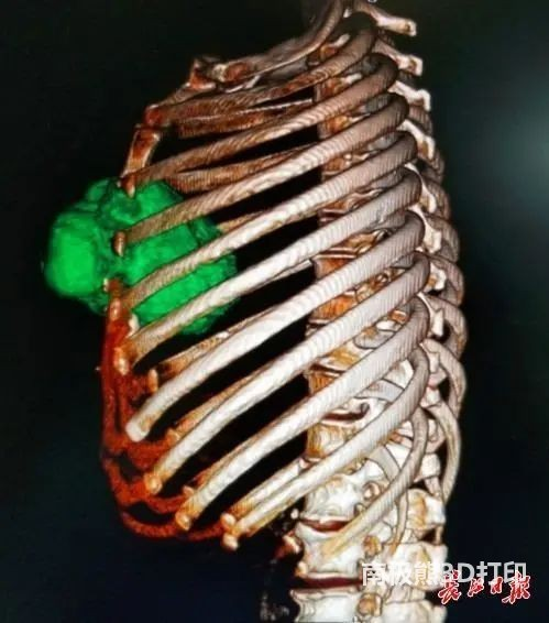 中部戰區總醫院3D打印“鈦合金胸”幫患者保心護肺