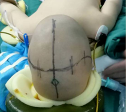 鄭大三附院用3D打印技術為3歲小孩治療狹顱癥