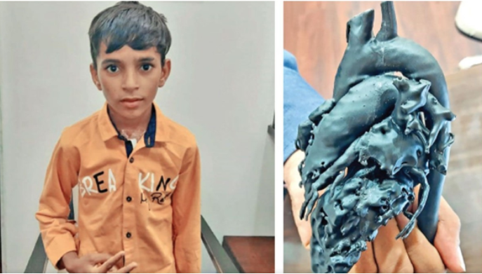 3D打印挽救生命！打印心臟模型助力完成罕見心臟手術病例