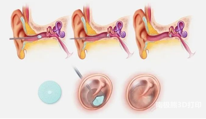 哈佛科學家研發的3D打印鼓膜修復貼片已經進入商業生產