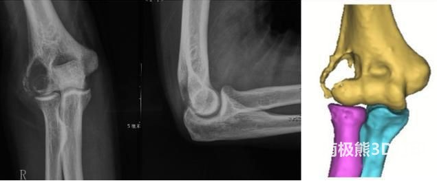 個性化、精準(zhǔn)化，煙臺山醫(yī)院將3D打印技術(shù)應(yīng)用于骨腫瘤手術(shù)