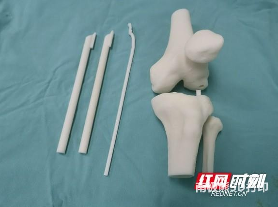 23歲小伙打球扭傷膝蓋 3D打印助力精準(zhǔn)微創(chuàng)手術(shù)