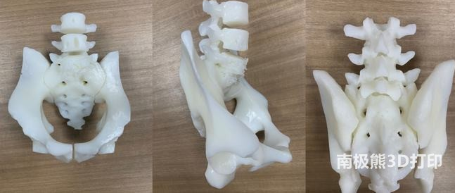3D打印技術助力脊柱手術，讓患者重獲新生