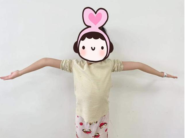 煙臺山醫(yī)院完成3D打印輔助截骨矯形治療兒童肘內(nèi)翻畸形手術(shù)